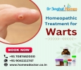 Cure Your Warts with Homeopathic Medicine Completely